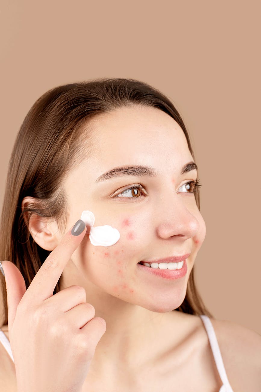 Young woman smiling while applying cream to acne-affected skin, promoting skincare routine.