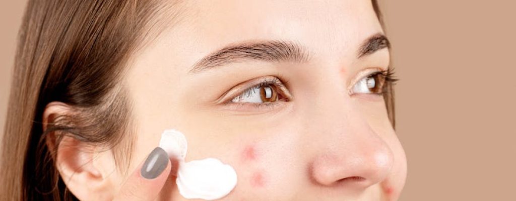 Young woman smiling while applying cream to acne-affected skin, promoting skincare routine.